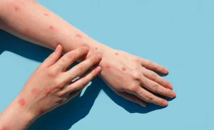 monekypox virus
