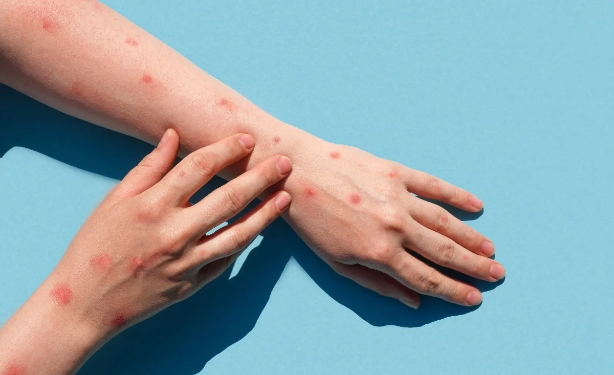 monekypox virus